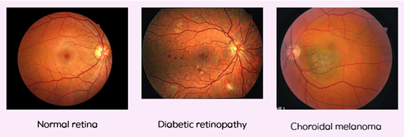Retinal imaging examples